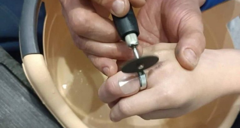 Спасатели Удмуртии помогли снять кольцо с пальца 13-летней девочки