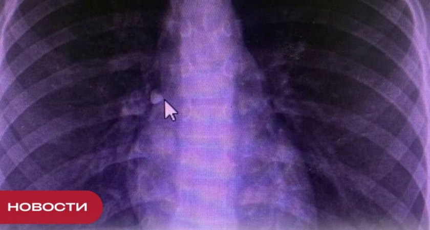 В Удмуртии маленький ребенок проглотил молочный зуб