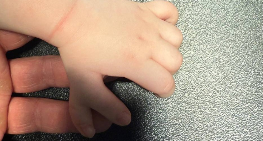 Ребенка с редкой врожденной аномалией прооперировали в Удмуртии