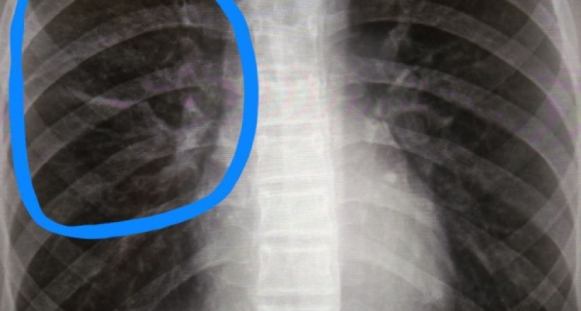 С начала года в Удмуртии выявлено более 600 случаев заболевания раком легких