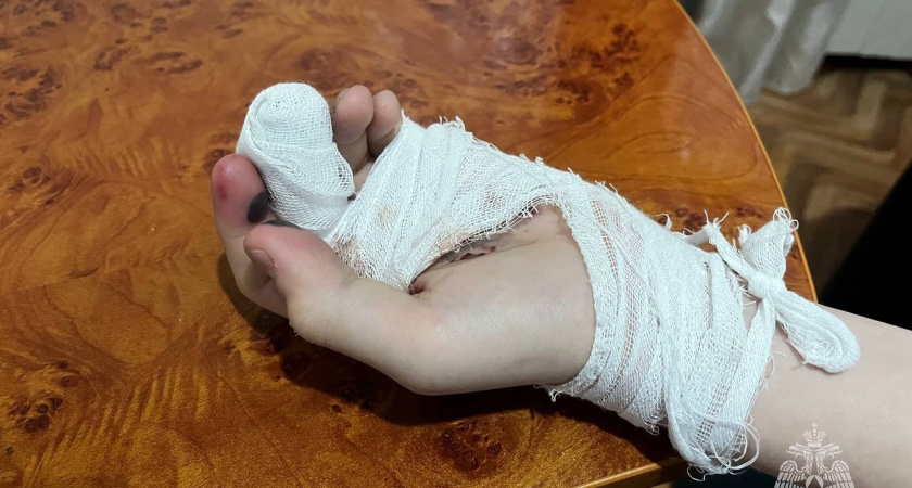 В Удмуртии ребенок получил травму от взрыва петарды в руках