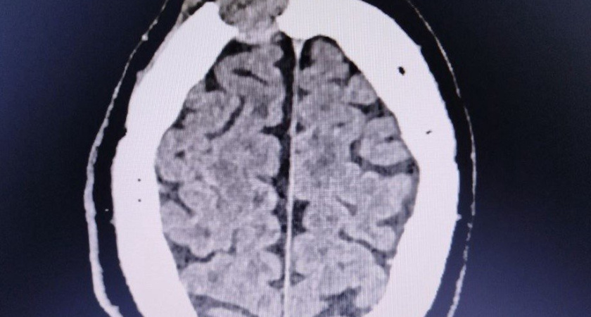 В Удмуртии нейрохирурги спасли пациенту лобную кость